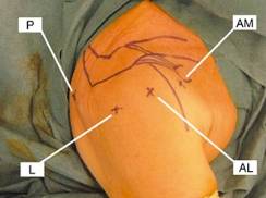 Incisions pour la chirurgie arthroscopique de l'épaule
