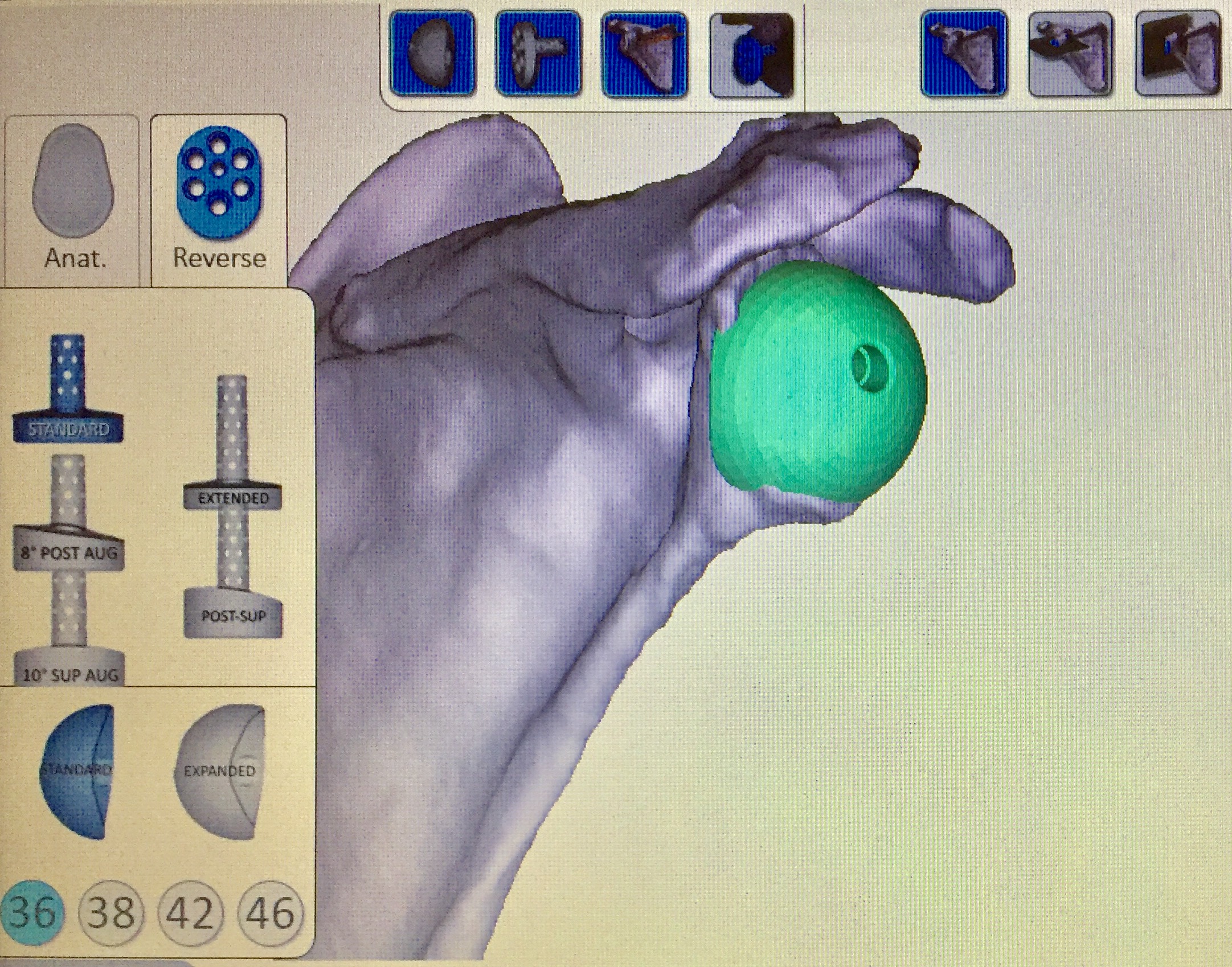 Exemple de planification pré-opératoire d'une prothèse inversée de l'épaule