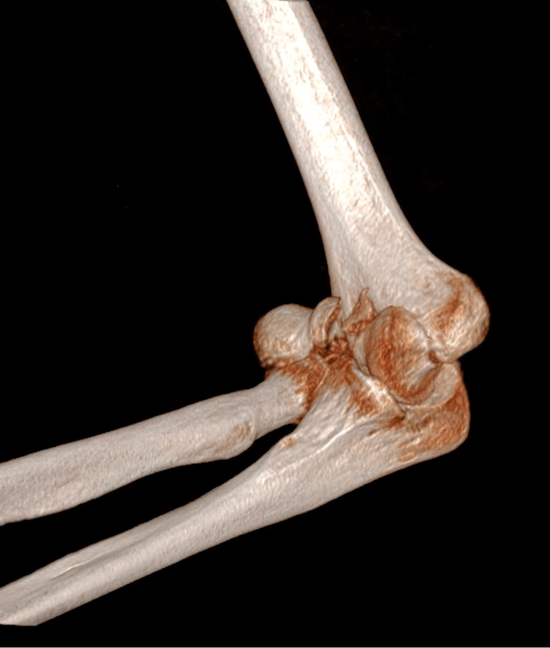 Fracture complexe de l’extrémité inférieure de l’humérus chez une personne âgée