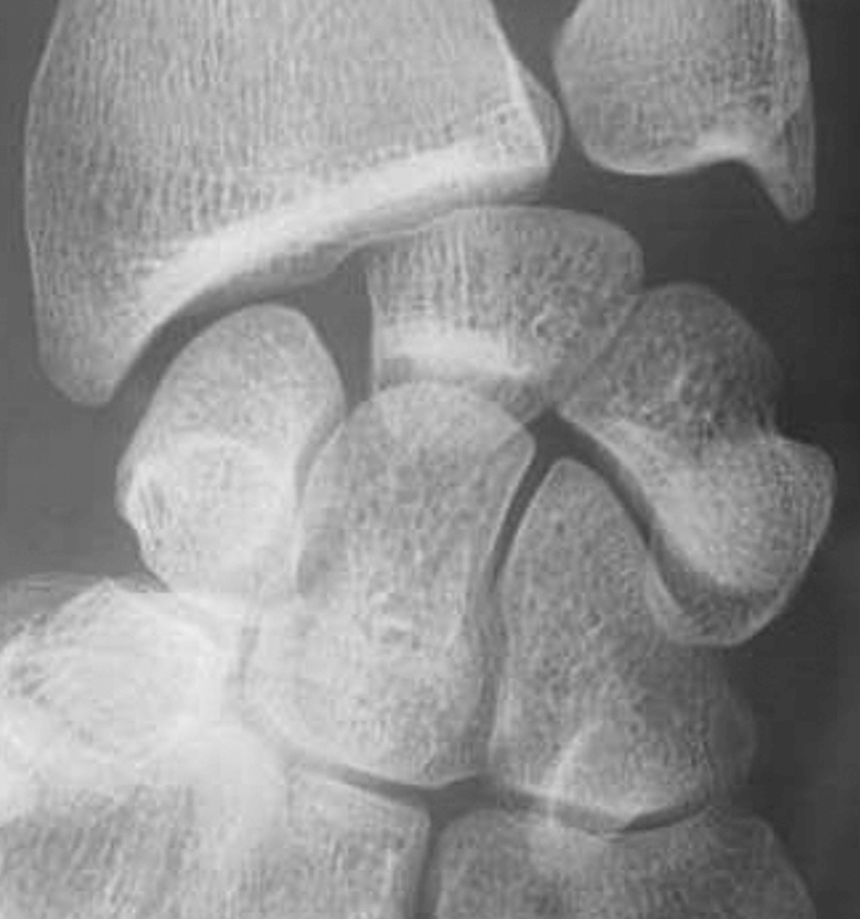 Rupture du ligament scapho-lunaire avec instabilité intra-carpienne