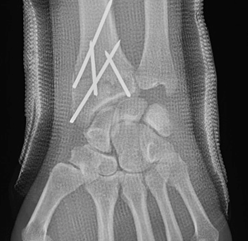 Fracture du radius - Fracture du poignet sous contrôle arthroscopique
